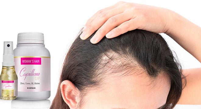 queda e calvície em mulheres Womans Hair Capillum