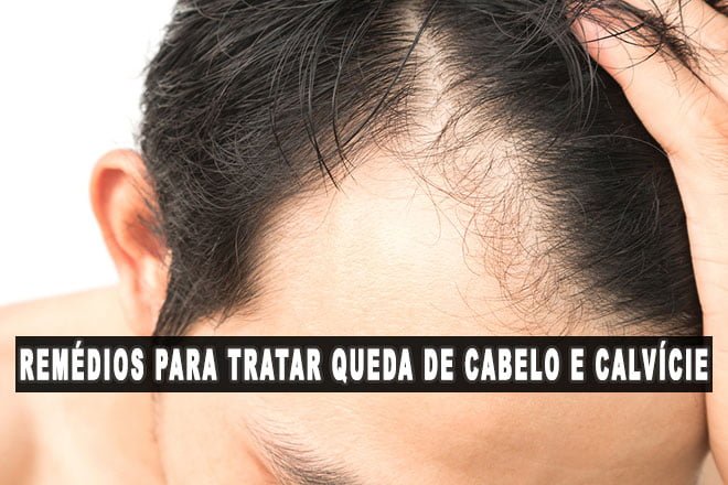 11 Melhores Remédios e Suplementos para Queda de Cabelo e Calvície