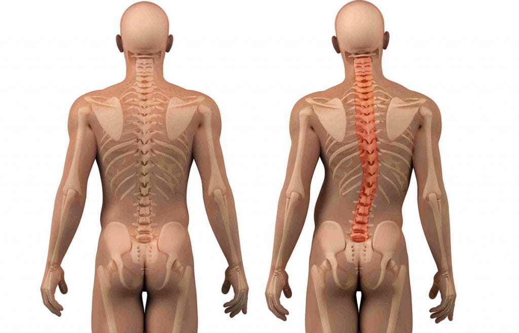 escoliose exercícios evitar musculação