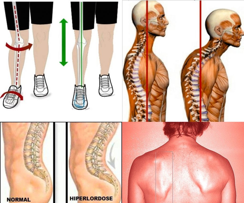 Musculação aplicada a melhora dos desvios posturais: Como treinar? desvios posturais exercicios treino musculação