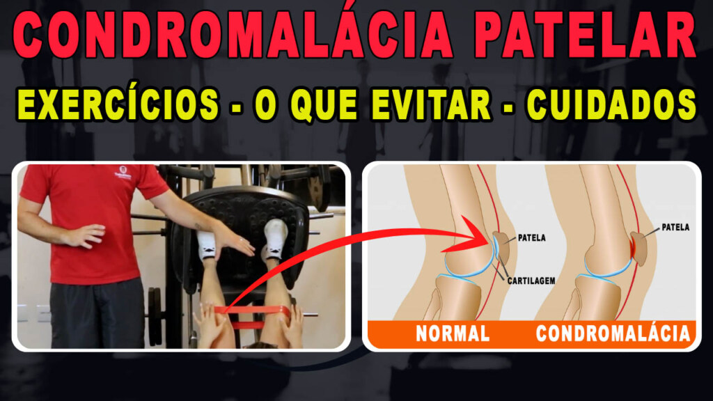 condromalacia patelar exercicios